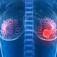 inteligencia artificial como método para detectar el cáncer