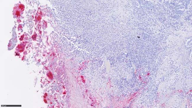 Fusobacterium nucleatum metástasis