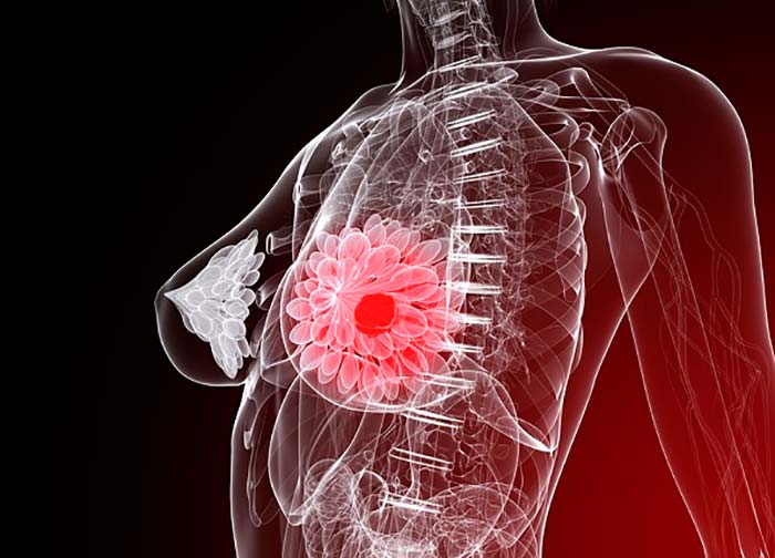 La proteína MSK1 mantiene “dormidas” las células metastásicas del cáncer de mama