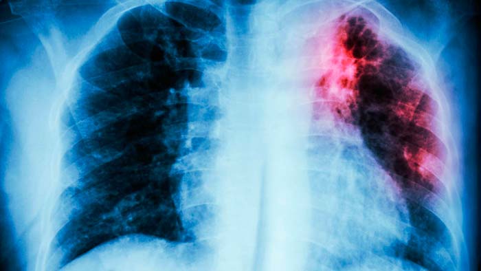 curar la fibrosis pulmonar portada