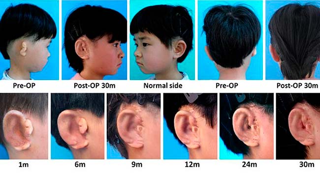 implantación orejas impresas 3D
