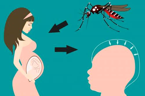 microcefalia virus Zika