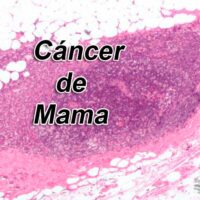 eliminaron el cancer de mama con un autotransplante portada