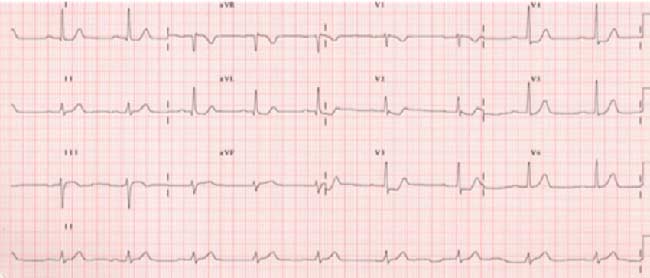 analisis de datos del ECG de 12 derivaciones para sindrome coronario agudo