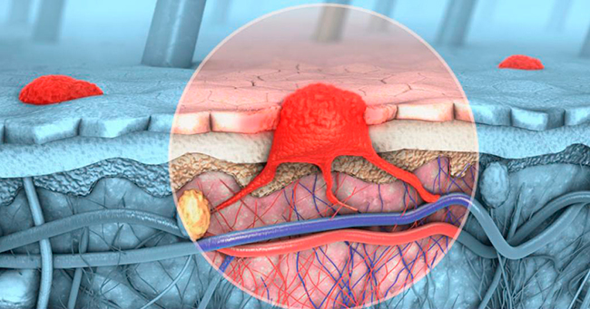 melanoma avanzado