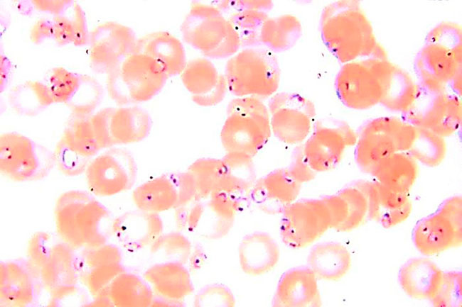 eritrocitos con malaria