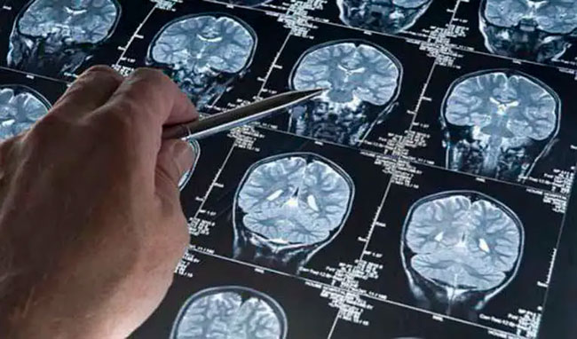 descubrimiento de la proteína TREM 2 en el cerebro