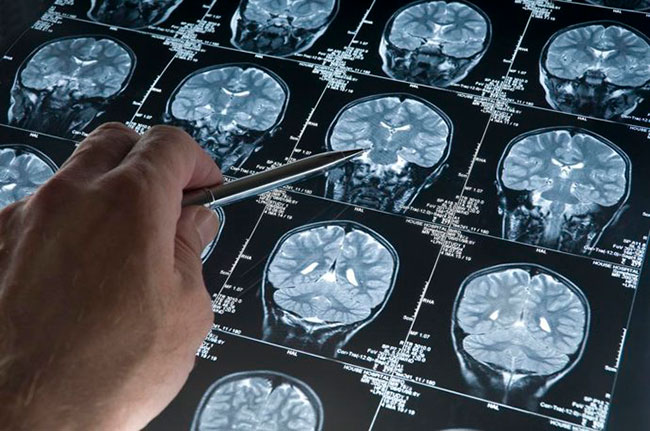 detección de Alzhéimer en cerebro